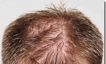 Hair restoration procedure results