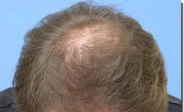 Hair restoration procedure results