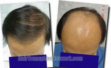 Hair restoration procedure results