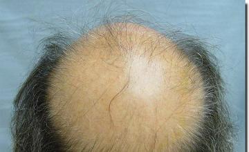 Hair restoration procedure results