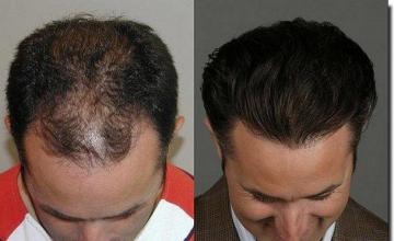 Hair restoration procedure results