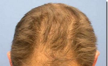 Hair restoration procedure results