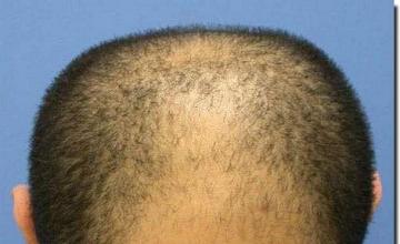 Hair restoration procedure results