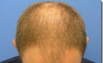 Hair restoration procedure results