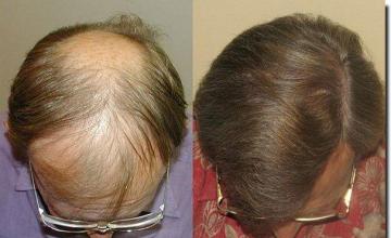 Hair restoration procedure results