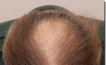 Hair restoration procedure results