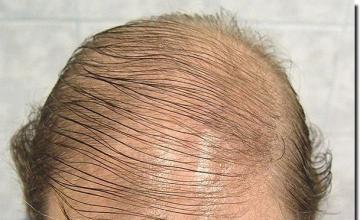 Hair restoration procedure results