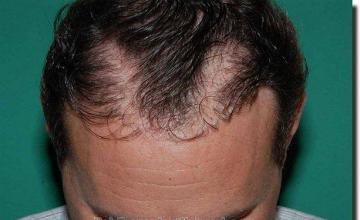 Hair restoration procedure results