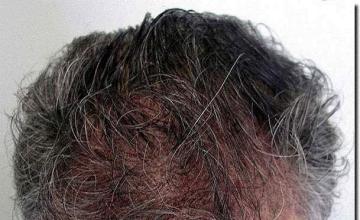 Hair restoration procedure results