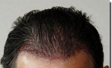 Hair restoration procedure results