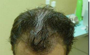 Hair restoration procedure results