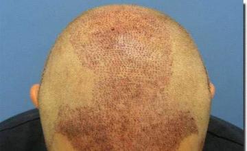 Hair restoration procedure results