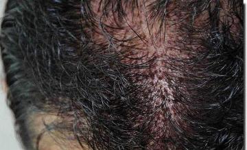 Hair restoration procedure results