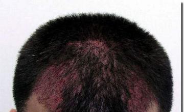 Hair restoration procedure results