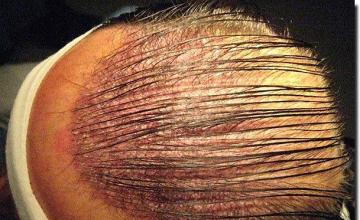 Hair restoration procedure results