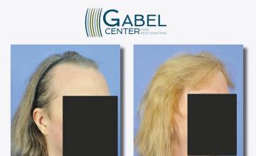 Hair transplantation surgery before and after photos