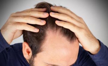 Alopecia Areata: Patchy Hair Loss and How to Treat It