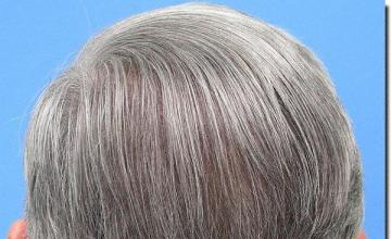 Hair restoration procedure results