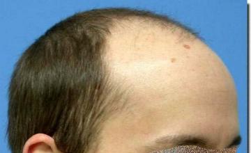 Hair restoration procedure results