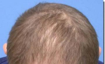 Hair restoration procedure results