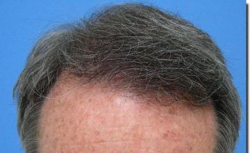 Hair restoration procedure results