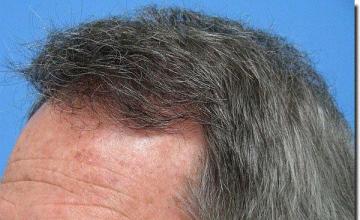 Hair restoration procedure results