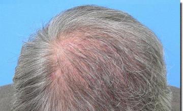 Hair restoration procedure results