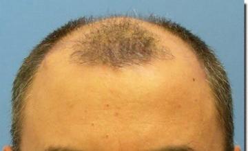 Hair restoration procedure results