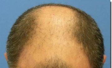 Hair restoration procedure results