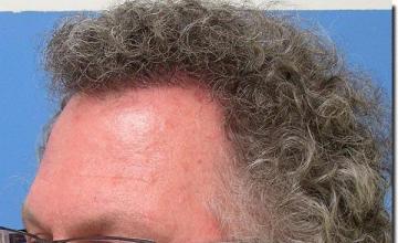 Hair restoration procedure results