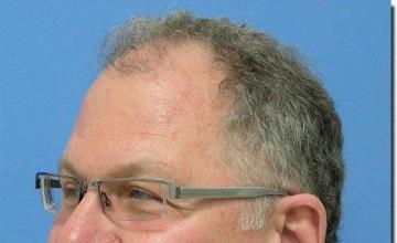 Hair restoration procedure results