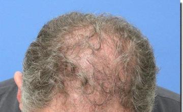 Hair restoration procedure results