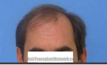 Hair restoration procedure results