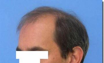 Hair restoration procedure results