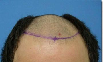 Hair restoration procedure results