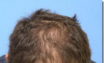 Hair restoration procedure results