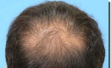 Hair restoration procedure results