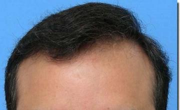 Hair restoration procedure results