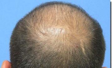 Hair restoration procedure results