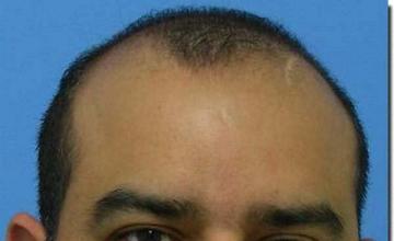 Hair restoration procedure results