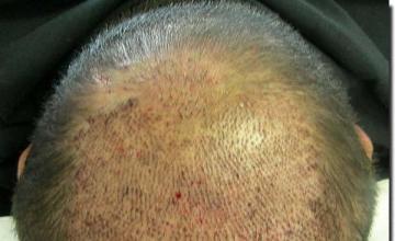 Hair restoration procedure results