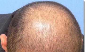 Hair restoration procedure results